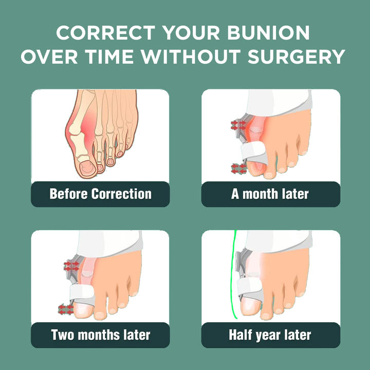 LAST DAY - 30% OFFBunionFixed™- Bunion Corrector Splint